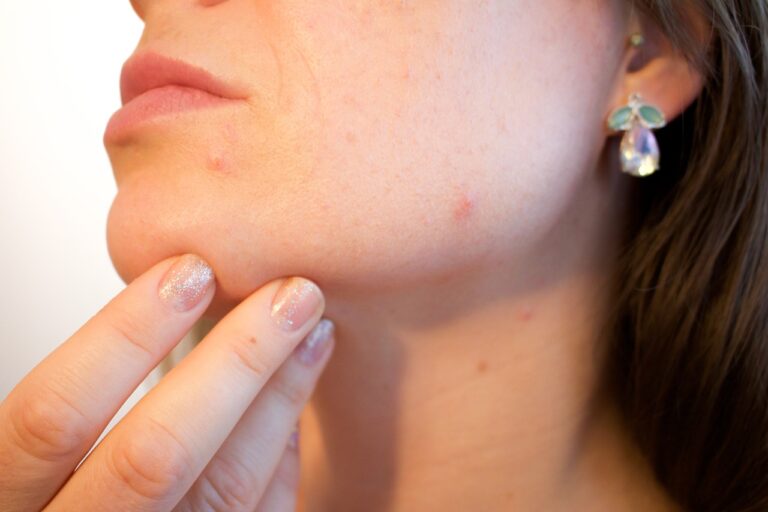 Pimples: Types, Prevention, and Treatment